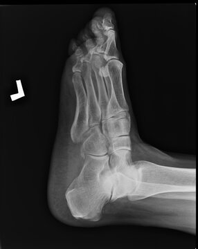 X-ray (projectional radiograph) of the foot of a 64-year-old female, lateral projection