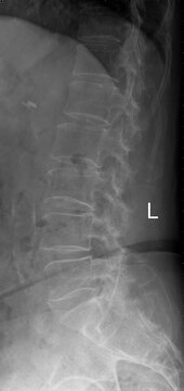 An X-ray, the lateral projection of the lumbar spine of a 68-year-old female 