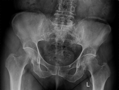 An X-ray. An anteroposterior (AP) view of the pelvis of a 68-year-old woman