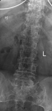 An X-ray, the anteroposterior (AP view) projection of the lumbar spine of a 68-year-old female