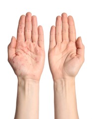 Fototapeta premium A pair of human hands with one palm displaying red blemishes
