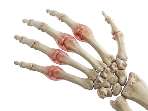 Rheumatoid arthritis hand bones anatomical visualization exhibiting joint inflammation swelling ulnar deviation and tissue erosion representing chronic autoimmune orthopedic disease