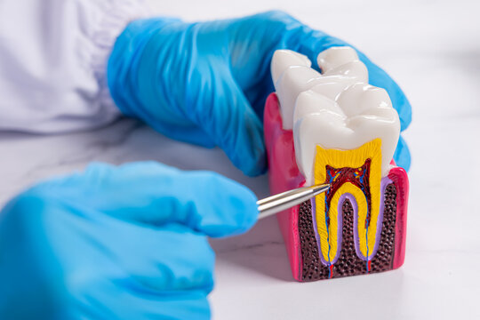Un dentiste examine un mod&egrave;le de dent avec des gants bleus et un pic dentaire.