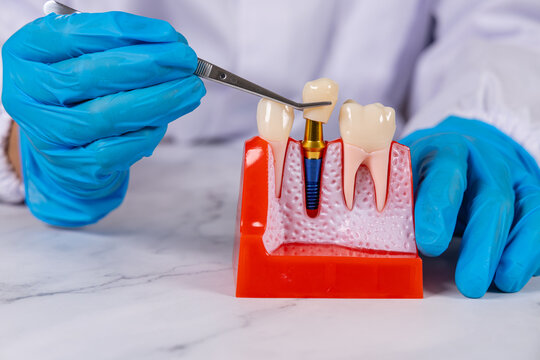Un dentiste en action mettant la couronne d'un implant dentaire avec une pince. Ses mains ont des gants en nitrile bleu.