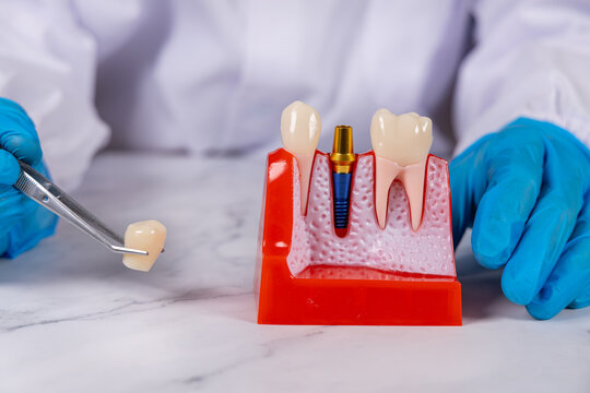Un dentiste en action prenant la couronne d'un implant dentaire avec une pince. Ses mains ont des gants en nitrile bleu.