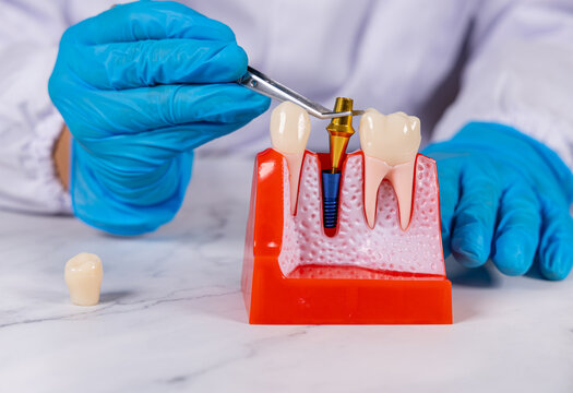 Un dentiste en action mettant le pilier vis d'un implant dentaire avec une pince. Ses mains ont des gants en nitrile bleu.