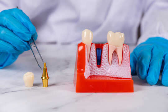 Un dentiste retirant un &eacute;l&eacute;ment d'un implant dentaire avec une pince. Ses mains ont des gants en nitrile bleu.