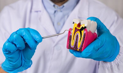 Un dentiste avec des gants bleus en nitrile en train de montrer une dent infectée par une carie...