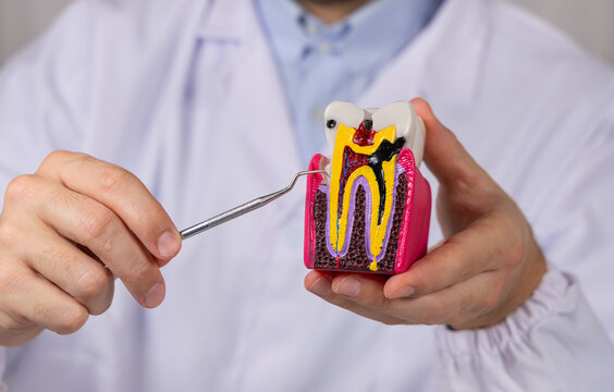 Gros plan sur un dentiste en train de montrer une dent infect&eacute;e par une carie avec un pic anti calcaire. En arri&egrave;re plan, il est habill&eacute; avec une blouse blanche m&eacute;dicale.