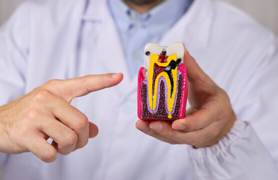 Un dentiste en train de pointer avec son doigt la structure d'une dent infect&eacute;e par une carie. En arri&egrave;re plan, il est habill&eacute; avec une blouse blanche m&eacute;dicale.