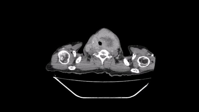 Chest CT scan  showing a mass in the upper chest indicating a cancer of the thyroid gland. And showing a secondary tumour in the right rib. And secondary tumour  in right and left lung 
