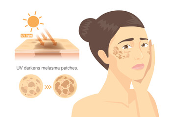 Woman touch her face with melasma on side cheek. UV light is the factor that causes melasma on skin surface. Melasma darken after exposure to sunlight.