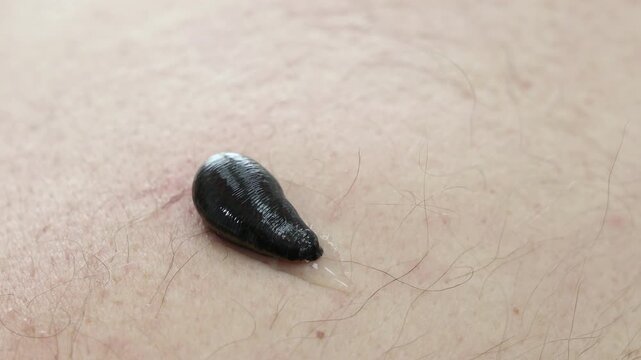 Hirudotherapy treatment with leeches at a medical clinic