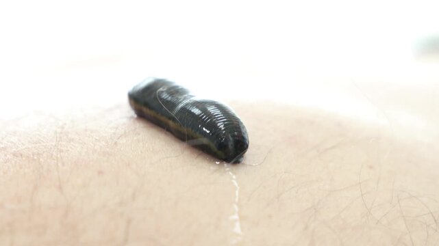 Hirudotherapy treatment with leeches at a medical clinic