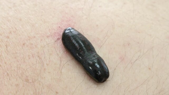 Hirudotherapy treatment with leeches at a medical clinic
