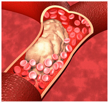 3D Rendering Illustration of an Atheroma Plaque with difussed red background, which is an accumulation of lipids, inflammatory cells, and fibrotic tissue in the arterial wall that reduces blood flow.