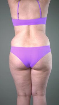 Overweight female back view showing fat and love handles, with flabby, saggy buttocks, cellulite and cellulitis before liposuction