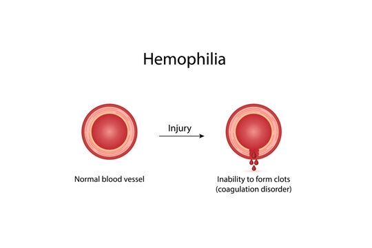 Hemophilia, a bleeding disorder that slows the blood clotting. Haemophilia (Coagulation disorder). Damaged blood vessel, hemorrhage. Healthy blood vessel after bleeding. Vector illustration..