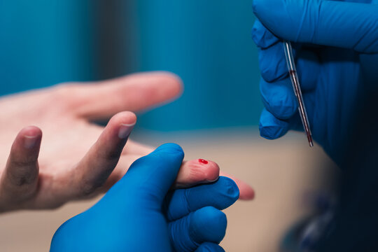 phlebotomist using capillary tubes to collect sample blood