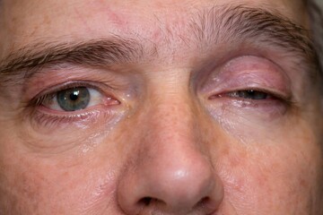 Fototapeta premium A close‑up of the eyes showing one swollen, partially closed eyelid with surrounding redness, highlighting ocular swelling, eyelid changes, and clinical evaluation of eye conditions.