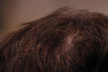 中年男性の頭頂部の薄毛と頭皮の状態