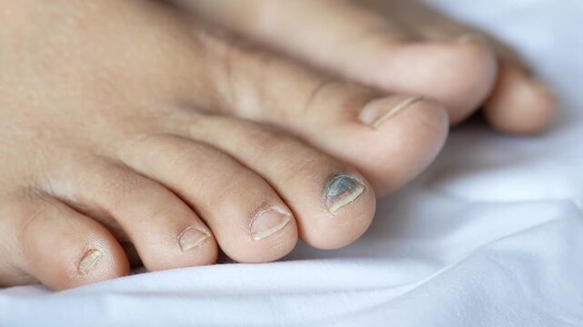 Subungual hematoma on human toe nail showing dark bruising and discoloration after injury