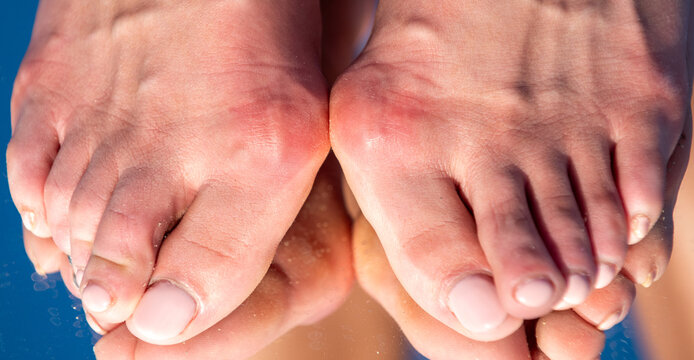 Hallux valgus deformity of big toe joint. Bare foot with Hallux valgus deformation. Female foot sole with deformities. Hallux Valgus on female feet close up. Feet of woman with hallux valgus.