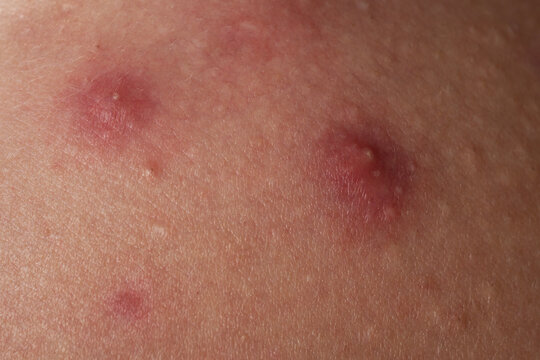Macro shot of skin irritation with acne. Inflamed skin bumps acne macro. Skin problem background with infected bumps and acne. Detailed skin with acne.