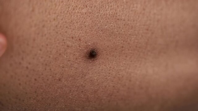 A large brown mole on the skin