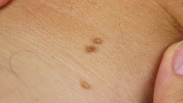 Dermatology body diseases papilloma or melanoma. Mole big wart on skin. Oncology malignant tumor