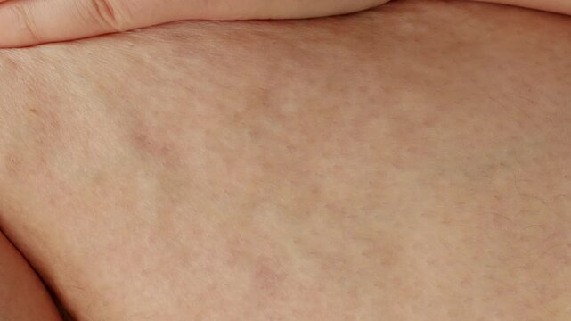 Female legs thighs with cellulite close up. Skin problem, body care, overweight and dieting concept, diabetic risk factor