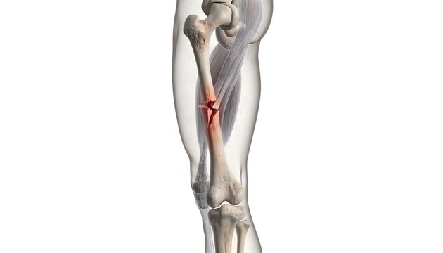 Detailed 3D medical illustration of a fractured human tibia. Featuring translucent calf muscles and a highlighted red break on the shin bone, isolated on a white background for educational use.