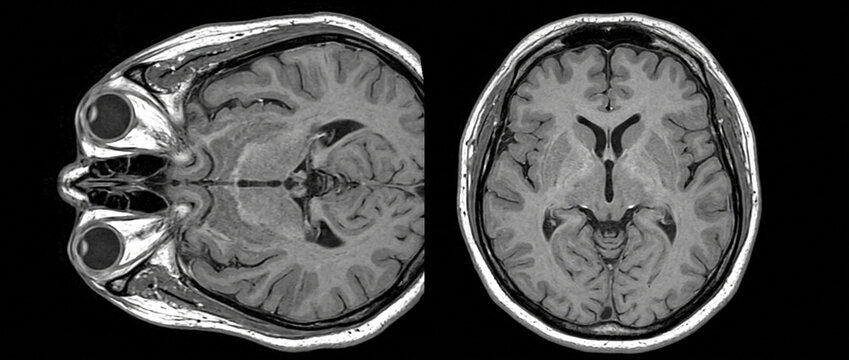 Detailed MRI scan showing axial and coronal views of the human brain, highlighting internal structures and the optic nerves, presented as a medical diagnostic vector