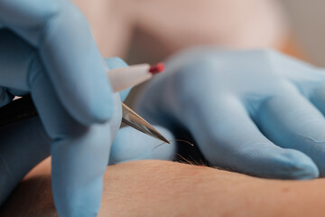 Electrolysis Hair Removal with Needle Probe and Tweezers on Female Skin