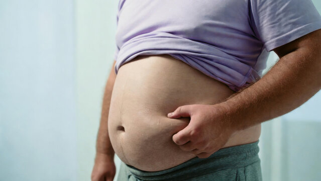 Man pinching his large belly, showing excess fat and weight gain concerns