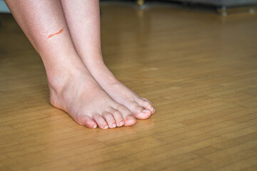 Friction Blister on Heel of Bare Foot. Close-up of Skin Abrasion on Wooden Floor.