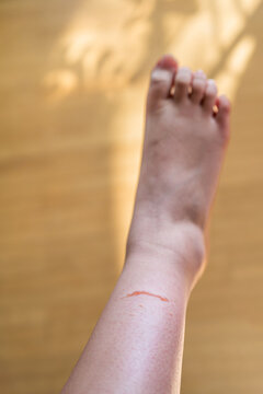 Friction Blister on Heel of Bare Foot. Close-up of Skin Abrasion on Wooden Floor.