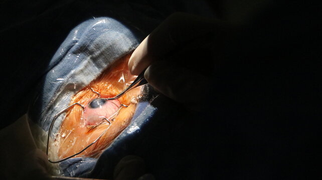 CIRUGIAS DE CATATARAS INFANTILES