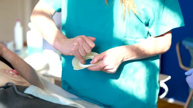Nurse smoothing edges of ostomy wafer opening to protect peristomal skin and ensure secure seal in stoma care