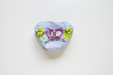 An orthodontic plate with an orthodontic screw for widening a child's upper jaw. Correcting dental alignment in children is a medical concept. © dore art