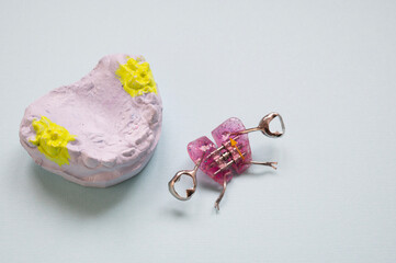 An orthodontic plate with an orthodontic screw for widening a child's upper jaw. Correcting dental alignment in children is a medical concept. © dore art