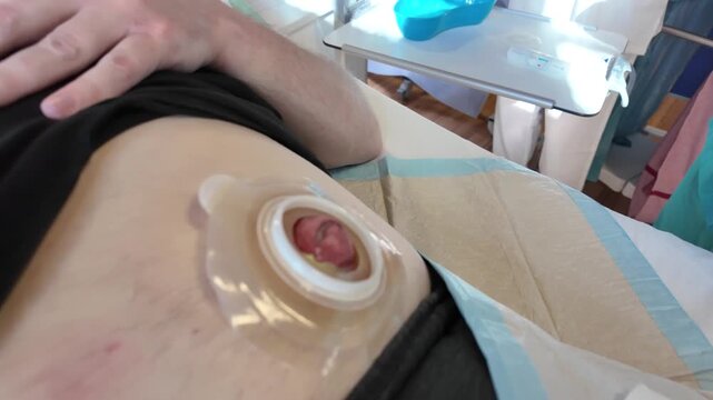 Nursing instructor explaining ostomy bag care to student nurse during colostomy patient training