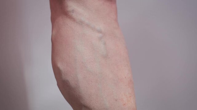 Close-up of an elderly woman's leg with varicose veins