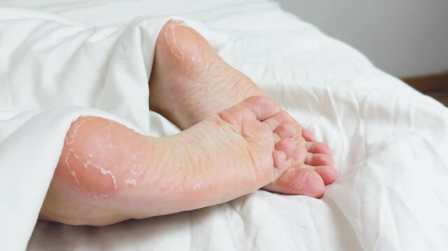 Person's feet with severe dry skin, peeling skin, and cracked heels on clean white bed sheets, illustrating need for dermatology, foot care, exfoliation, hydration, and treatment for calluses