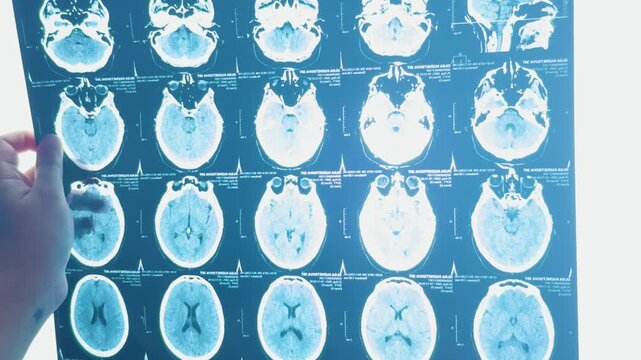 Medical professional examining multiple computed tomography - ct - scans highlighting different views and slices of a human brain for diagnostic purposes, analyzing neurological conditions