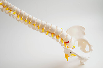 Obraz premium Spinal nerve and bone, Lumbar spine displaced herniated disc fragment, Model for treatment medical in the orthopedic department.