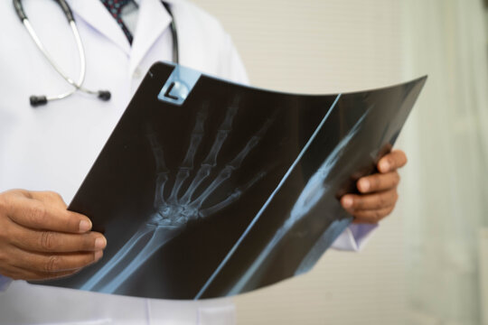 Doctor examining hand ankle joint bone radiography xray film.