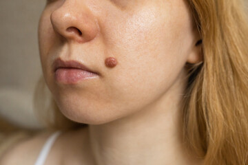 Fototapeta premium A mole on a woman's cheek. A large melanocytic papillomatous intradermal nevus. 