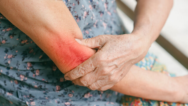 Close up of senior woman holding painful elbow with red inflammation area, symbolizing arthritis, joint inflammation or tendonitis. Elderly healthcare and chronic pain management concept.