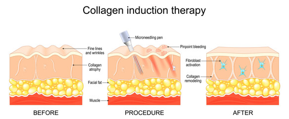 Collagen induction therapy. Before and After Microneedling procedure.